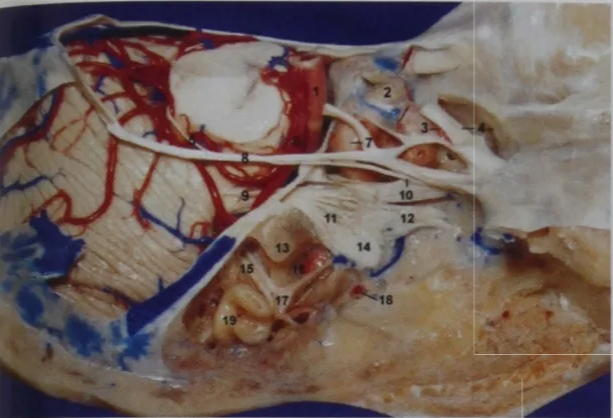 12 18 FIGURE 12. Lateral view of the right cavernous sinus; the lateral wall of the cavernous sinus has been peeled off to display the con- tents of the cavernous sinus. The anterior clinoid process and the tentorium have been removed as well. The part of the mesial tem- poral lobe that is located below the tentorial groove is related to the cavernous sinus. I, basilar artery; 2, pituitary gland; 3, supracli- noidal segment of the internal carotid artery and ophthalmic artery; 4, optic nerve and sphenoid sinus; 5, trochlear nerve; 6, superior cerebellar artery; 7, posterior bend of the cavernous carotid artery and oculomotor nerve; 8, tentorial edge; 9, trigeminal nerve; 10, VI and trochlear nerve; 11, Gasserian ganglion; 12, V2; 13, petrous apex; 14, V3; 15, facial and superior vestibular nerves; 16, petrous carotid artery; 17, geniculate ganglion; 18, middle men- i arte • 19 semicircular canals. 