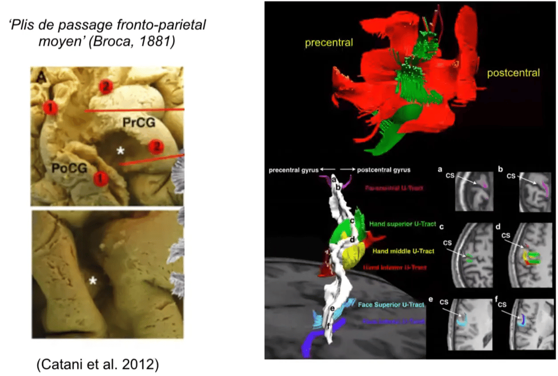 U-shaped fibres of the central SUICUS 'Plis de passage fronto-parietal moyen' (Broca, 1881) PrCG (Catani et al. 2012) precentral postcentral pr«entral gyrus postcentral gyrus Hand superior U-Tract U.TrE1 Face Superior 