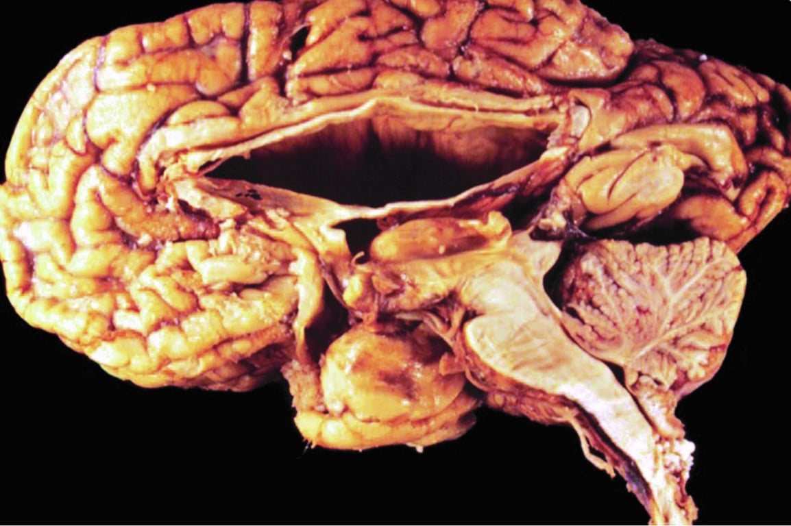 Figure 2: elongated, pointed cerebellar tonsils w/ hydro (corpus callosum thinning)