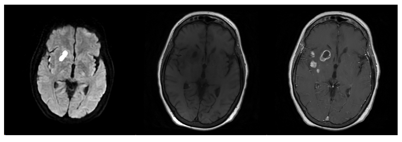 Figure 1: (LEFT): DWI shows diffusion restriction with (MIDDLE/RIGHT) T1 and T1+c sequences showing classic rim-enhancing