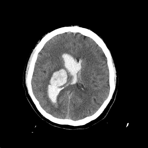 Figure 3: Hypertensive RIGHT thalamic bleed with significant intraventricular extension, ventriculomegaly, and hydrocephalus. 