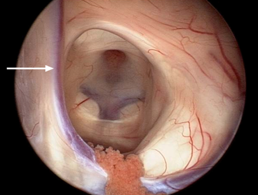Figure 1: Septal vein seen through R lateral ventricle view of foramen of Monro. Columns of fornix form anteiror/superior margins of the foramen.