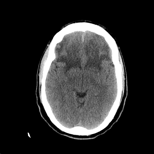 Figure 1: CTH showing the diffuse bifrontal edema of a midline invasive skull base SSC
