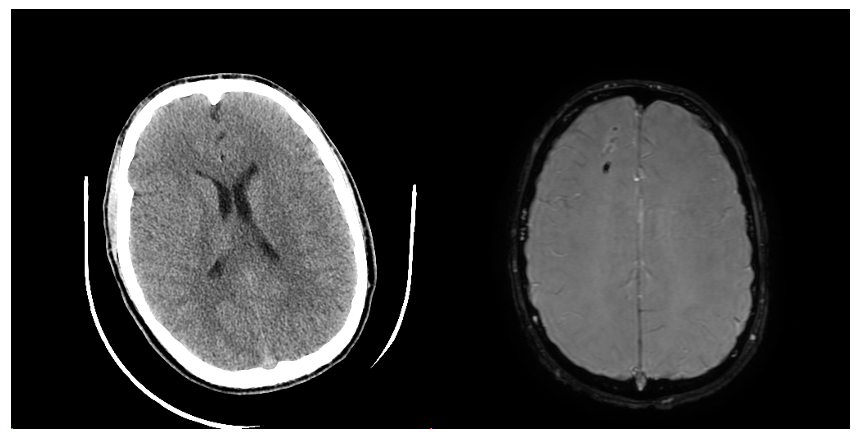 Figure 1: (LEFT) negative CT scan (RIGHT) Grade 1 R frontal DAI 