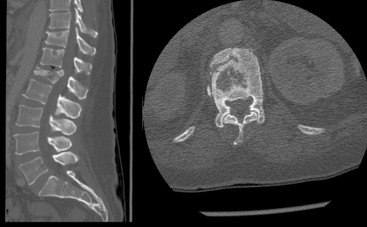 Figure 1: L1 complete burst fracture with significant bony retropulsion into spinal canal