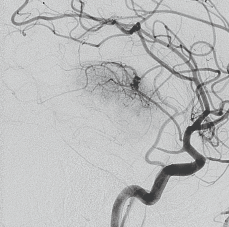 AChA supplying a tumor