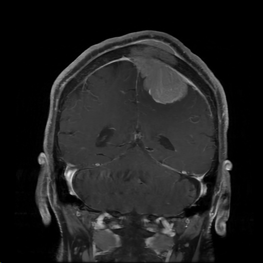 Parasagittal meningioma with galeal invasion