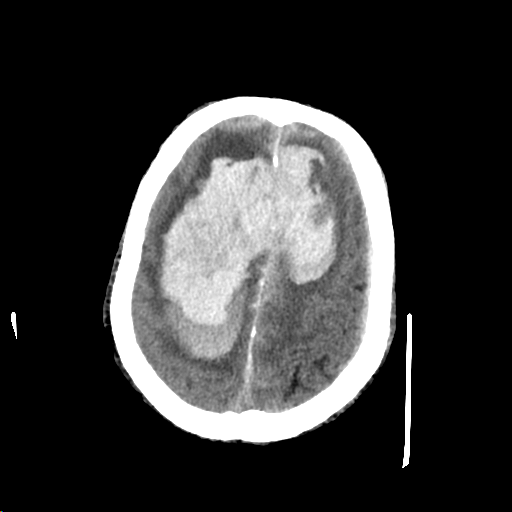 Figure 2: Hypertensive bi-hemispheric IPH. This was such a profound bleed with origin of bleed difficult to determine however patient was SBP to 200s at time of presentation. 