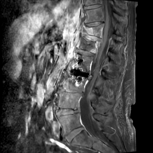 Figure 1: MRI w/ contrast showing T12/L1 disc osteo