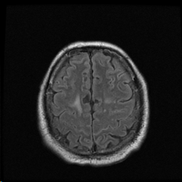 Lack of T2 FLAIR suppression in posterior parieta sulci