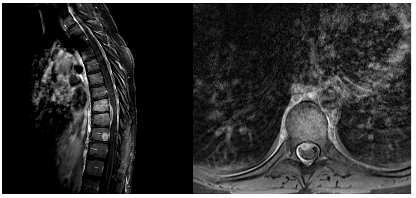 peripheral rim-enhancing ventral epidural abscess in a previously healthy young adult found to have MSSA bacteremia. 