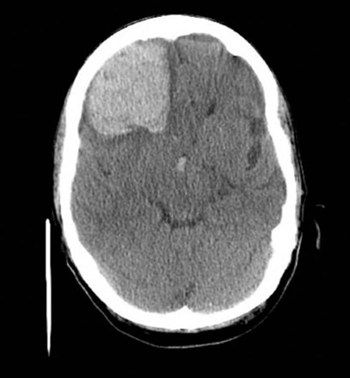 Figure 1: Lobar Amyloid Bleed