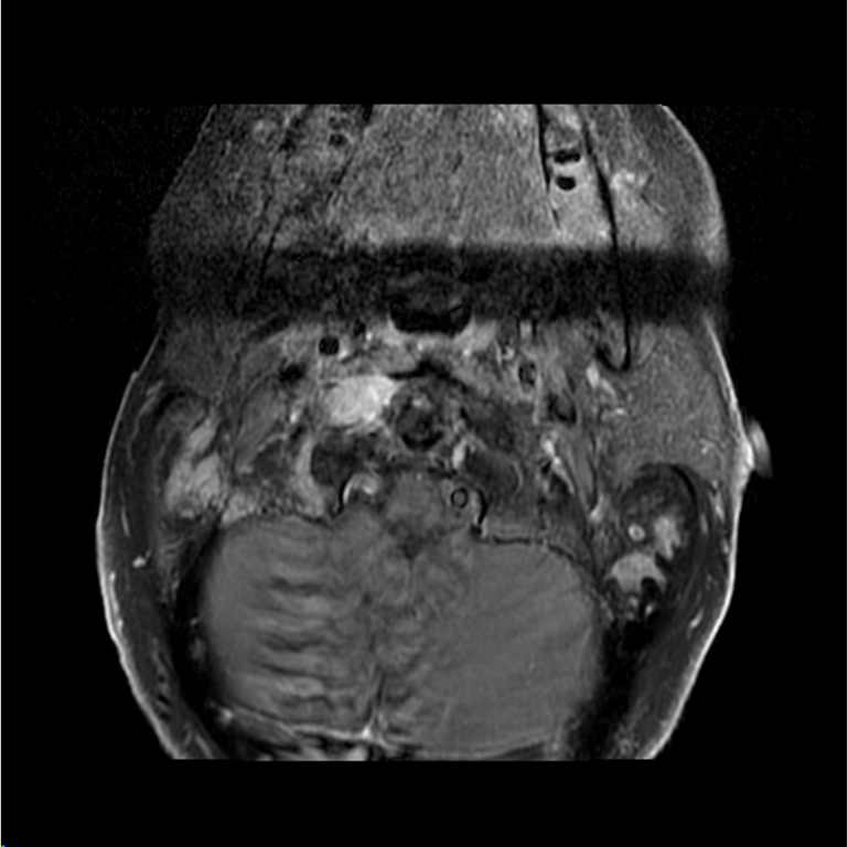 Figure 1: pathologic anterior arch of R C1 fx 