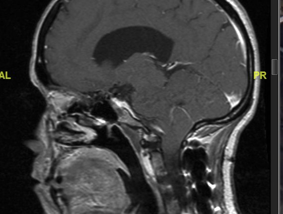 Figure 1: peg-like extension of tonsils ~1.5cm below foramen magnum
