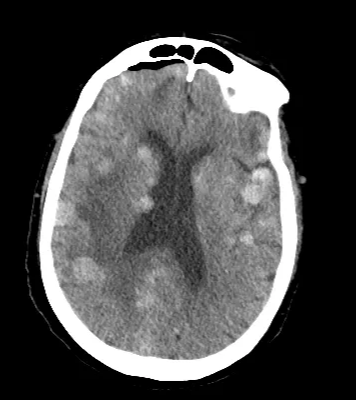 Figure 1: Miliary melanoma (carcinomatosis encephalitis) - dire prognosis