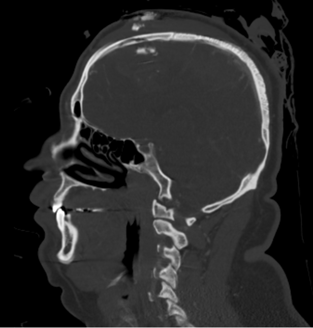 Figure 1: anterior sinus pentration 