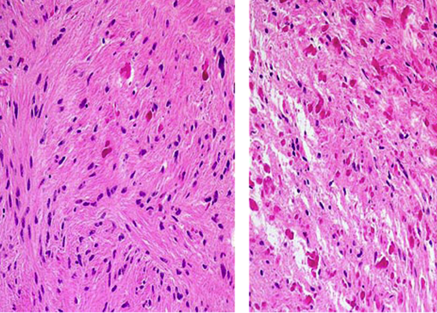 Figure 1: Pathology features: Rosenthal fibers (brightly eosinophilic masses intermixed with tumor cells) 
