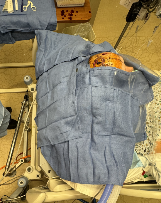 Placing a contraletral left EVD on patient with a right EVD already. Note how copious blue toweling is used. 