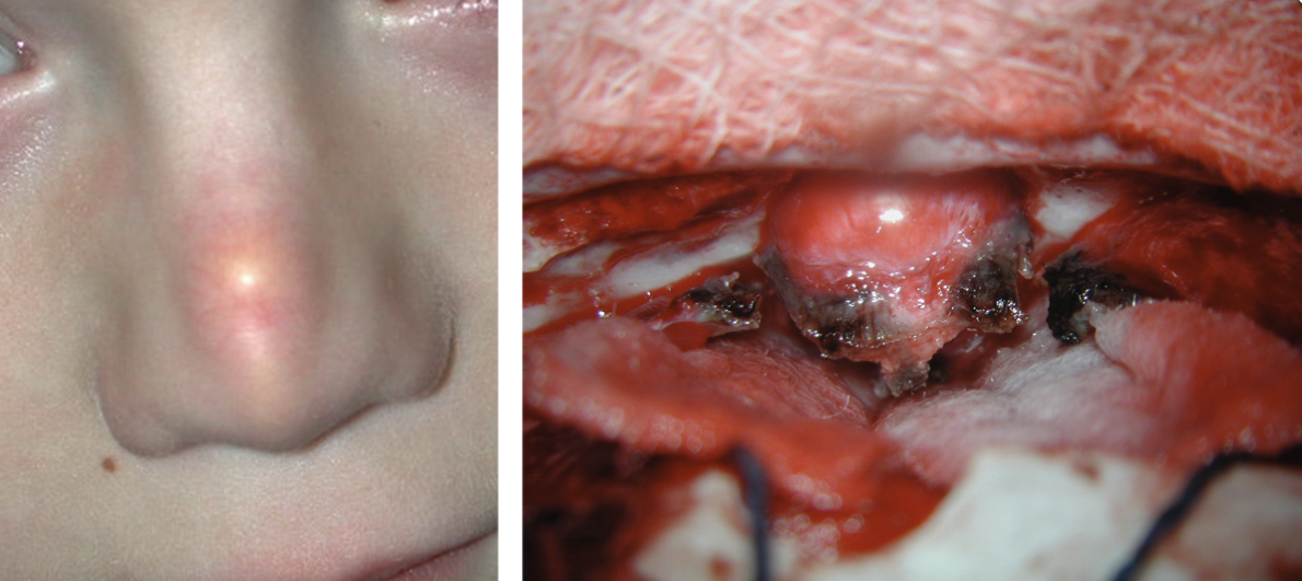 This can occur via invasion through foramen cecum. 