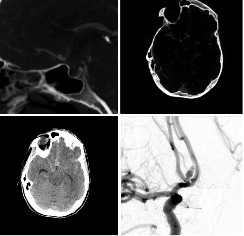 5mm anterior, superiorly, L projecting AComm aneurysm