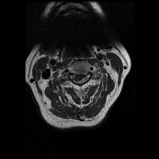 Figure 1: R central disc herniation causing severe stenosis (not even a thin rind of CSF seen)