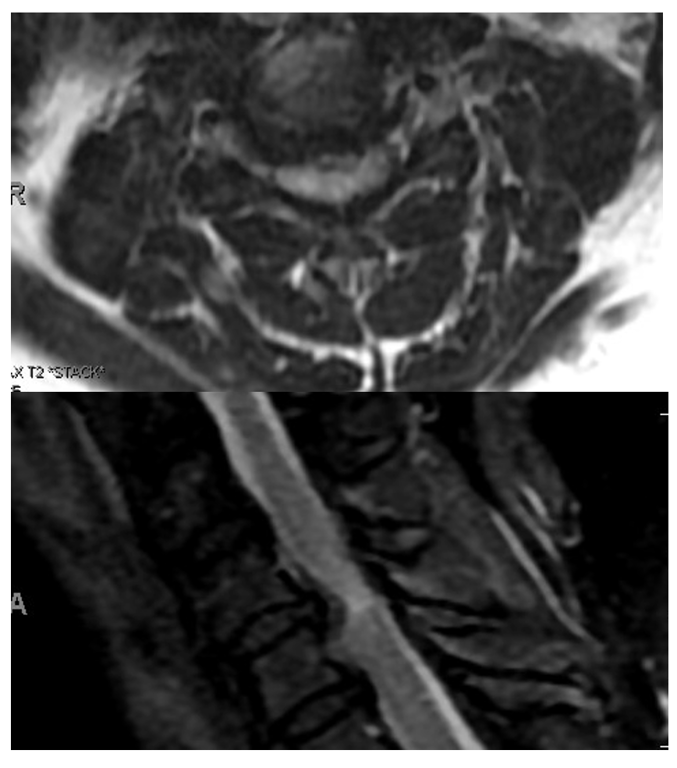 Figure 2: C4-5 broad-based disc bulge with moderate spinal stenosis but with T2 cord signal change. 