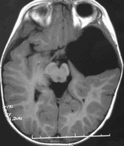 Middle cranial fossa arachnoid cyst