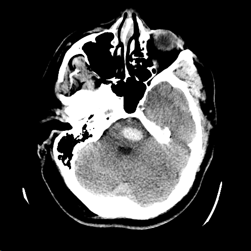Figure 4: Pontine hypertensive hemorrhage