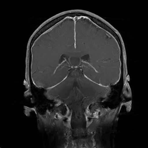 Figure 2: pachymeningeal enhancement 