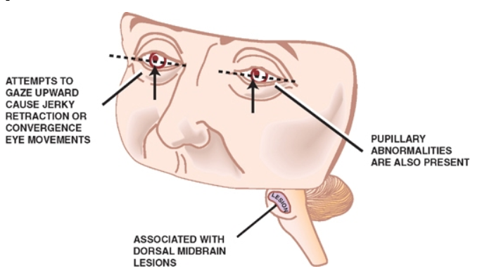 ATTEMPTS TO GAZE UPWARD CAUSE JERKY AE TRACTION OR CONVERGENCE EYE LOVELENTS ASSOCIATED WITH DORSAL WDBRAIN LESIONS PUPILLARY ABNORMALITIES ARE ALSO PRESENT 