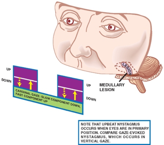 up CAR '*SAL MEDULLARY LESION NOTE THAT UPBEAT NYSTAGUuS OCCURS WHEN EYES ARE IN PRIMARY POSITION COMPARE GAZE-EVOKED NYSTAGMUS. WHICH OCCURS IN VERTICAL GAZE. 