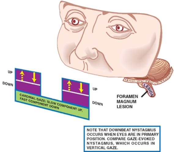 сом— МАбниМ еЕыон НОТЕ ТНАТ 00WHBEAT MYSTAGMUS ОССИЊ •,чнЕН EYES ПЕ рн.мдяу Роытюм сомРаяе HYSTAGMUS, occuas GAZE, 