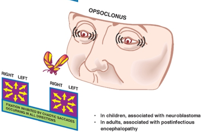 • In children, associated with neuroblastortu • In adults, associated with postiMectious 
