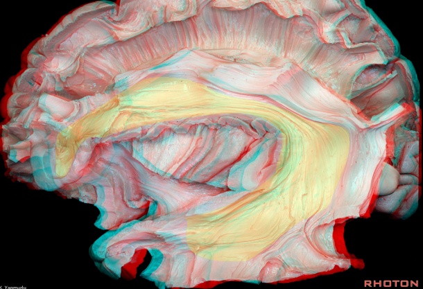 Arcuate (long) fasciculus