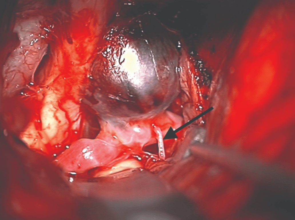 Arrow pointing to RAH seen in Acomm clipping