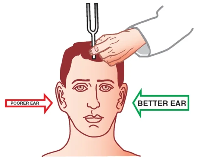 POORER EAR BETTER EAR • CONDUCTION DEAFNESS: PATIENT LATERALIZES SOUND TO THE AFFECTED EAR • SENSORINEURAL DEAFNESS: PATIENT LATERALIZES SOUND TO THE NORMAL EAR . NORMALLY. SOUND IS HEARD EQUALLY ON BOTH THE LEFT AND RIGHT SIDE 