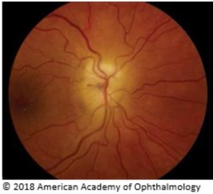 A close-up of a red blood vessels AI-generated content may be incorrect.