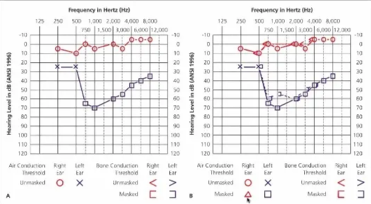Question 8 Frequency in Hertz (Hz) 125 250 500 1,000 2.000 4,000 8,000 750 1,500 3,000 6,000 12,000 Frequency in Hertz (Hz) 125 250 500 1,000 2,000 4,000 8,000 750 1,500 3,000 6,000 12,000 8 -10 10 20 30 50 70 80 90 100 110 120 Air Conduction Threshold Unmasked Right Ear o Left Ear x -o 20 30 40 60 70 80 90 100 110 120 Left Ea z 8 B -10 0 10 20 30 40 50 60 70 80 90 100 110 120 Air Conduction Threshold Unmasked Masked Right Ear o Left Ear x -10 10 20 30 40 50 60 70 80 90 100 110 120 Left Ear Bone Conduction Threshold Unmasked Masked Right Ear c Bone Conduction Threshold Unmasked Masked Right Ear c 