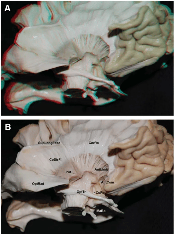 FIGURE 2. Images in 3 (A) and 2 (B) dimensions. Infemlateral view of the right hemisphere. The lenticular nucleus, anterior commissure (AntCom), occi- pitofrontal, superior longitudinal (SupLongFasc), and uncinare fascicles have been partially removed to expose the corona radiate (CORA), internal capsule, optic radiation (OptRnd), and optic tract (OptTr). Antl„imb, anterior limb of the internal capsule; COFO, column or pillar of the fornix; CoSnFi, cortical srriatal fibers; MaBo, mammillary body; put, putamen. Meyer'S optRad FIGURE 3. Images in 3 (A) and 2 (B) dimensions. View Of the roof Of the left temporal horn, where the ependyma, tapetum, and choroid plexus have been partially removed to disclose the origin and trajectory of the bundles of optic radiation (OptRad). The anterior bundle (AntB; red), central bundle (CenB; yellow), and posterior bundle (PostB; green) are shown. LatGeBo, lateral geniculate body; MeGeBod, medial geniculate body; OptTr, optic tract; Pulv, pulvinar of thalamus; UncFasc, uncinate fasciculus. 