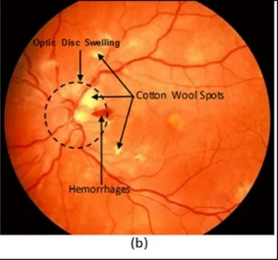 Arteriovenous ratio and papilledema based hybrid decision support system for detection and grading of hypertensive retinopathy - ScienceDirect