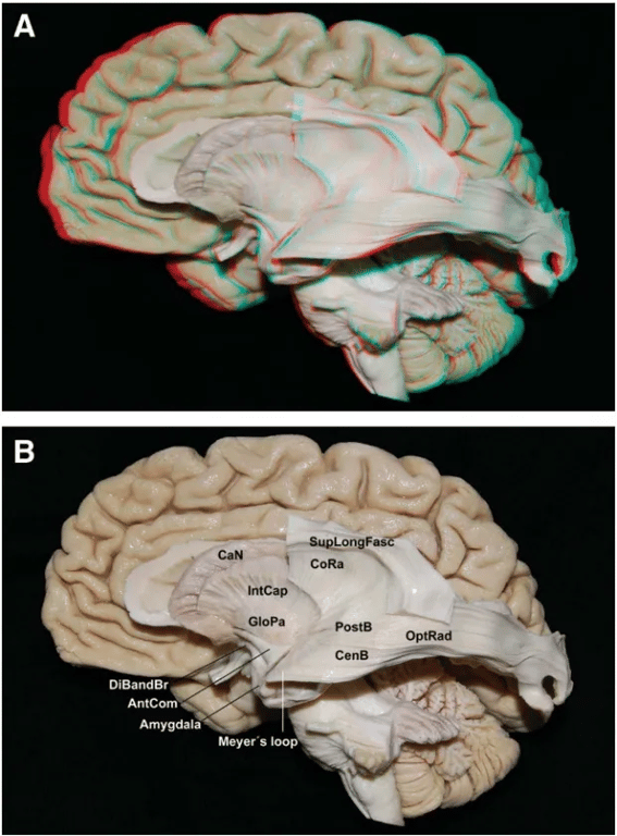 Spl Glopa Meyer-s loop CenB TapetumCS OptRad supLiöCaF DiBandBr AntCom FIGURE 4. Images in 3 (A) and 2 (B) dimensions. Lateral view. Optic radiation (OptRad) of the left hemisphere; the section of the superior longitudinal lus (SupLongFasc) allows exposure Of the central (CenB) and posterior bundles (PostB), which end at the lateral aspect of occipital pole and superior lip of the calcarinefissure, respectively. AntCom, anterior commissure; CalV, caudate nucleus; CORa, corona radiata; DiBandBr, diagonal band of Broca; GloPa, globus pallidus; IntCap, internal capsule. FIGURE 5. Images in 3 (A) and 2 (B) dimensions. Magnified view of the trajectory of 'be central and posterior bundles. The taperum constitutes the medial roof of the ventricular atrium. CenB, central bundle; OptRad, optic radiation; PostB, posterior bundle; SupLipCaF, superior lip of the calcarine fissure; SupLongFasc, superior longitudinal fasciculus; Spl, splenium Of the corpus callosum. 