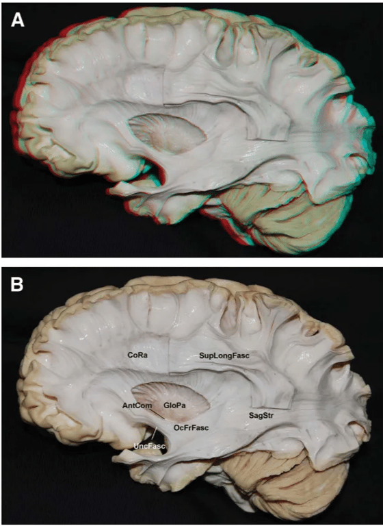 optRad Limon repo Inf. Temp. Sulcus FIGURE 6. Images in 3 (A) and 2 (B) dimensions. Lateral' view. The superior, middle temporal, angular, and occipital gyri were removed. Observe rhe optic radiation located deep to the superior and middle temporal gyri, above the inferior temporal sulcus. CS, central sulcus; Inf Temp. Sulcus, Inferior temporal sulcus; inferior limiting sulcus; IT G, inferior temporal gyrus; MFG, middle frontal gyms; optic radiation; PostCG, Postcentral gyms; PreCG, precentral gyms; SPLob, superior parietal lobe; TePo, temporal pole. FIGURE 7. Images in 3 (A) and 2 (B) dimensions. Lateral view of left hemisphere. Parts of the superior longitudinal fasciculus (Sup LongFasc) were removed to expose the corona radiata and the sagittal stratum (SagStr). Occi- pitofrontal (OcFrFasc) and uncinate fasciculus (UncFasc) can be identified Passing along the basal portion Of the insular cortex. AntCom, anterior com- missure; CORa, corona radia'e; Glopa, globus pallidus. 