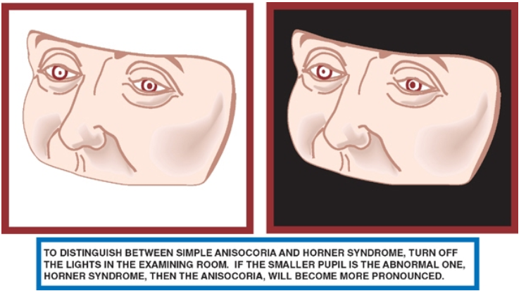 ΤΟ DlSTlNGlJlSH ςιΜΡΙΕ ΑΝΙςοτ:ολΙΑ ΑΝΟ TiJRN 0FF ΤΗΕ LlGHTS ΙΝ ΤΗΕ EXAMlNlNG ROOM. 1F ΤΗΕ SMALlER ΡυΡΙΙ ις ΤΗΕ ABNORMAL ΟΝΕ. HORNER SYNOROME. ΤΗΕΝ ΤΗΕ ANlsocORlA, wlLl BECOME MORE PRONOUNCEO. 