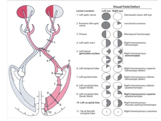 Visual field defects