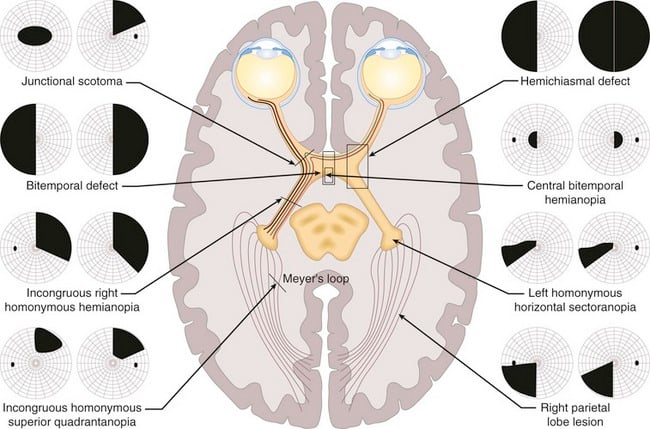 Junctional scotoma Bitemporal defect Incongruous right homonymous hemianopia Incongruous homonymous superior quadrantanopia Hemichiasmal defect Central bitemporal hemianopia Left homonymous horizontal sectoranopia Right parietal lobe lesion 