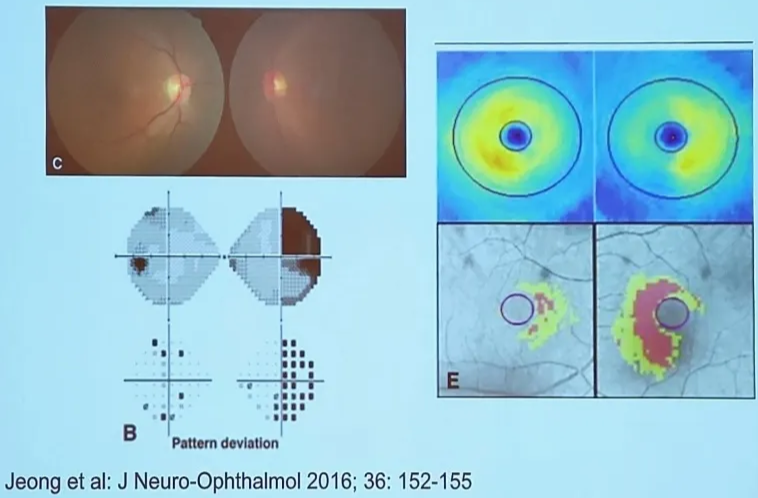 Pattern deviation Jeong et al: J Neuro-ophthalmol 2016; 36: 152-155 