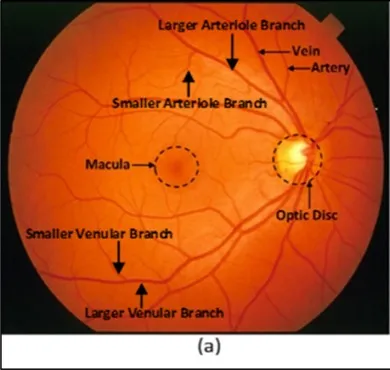 Arteriovenous ratio and papilledema based hybrid decision support system for detection and grading of hypertensive retinopathy - ScienceDirect