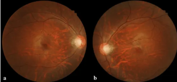 Fundoscopic photographs of the right eye (a) and left eye (b) of Patient 1. The fundoscopic photographs of Patient 1 revealed bilateral enlarged disc cupping of the optic nerves with sectorial excavation and reduction of the neural rim in the left eye