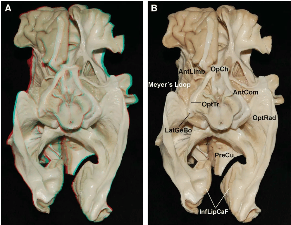 Meyer's Ch —AntCom optic' OptRad LatG Precu InfLipCaF FIGURE 13. Images in 3 (A) and 2 (B) dimensions. Basal view of the neural visual pathways. The temporal gyrus has been removed bilaterally, preserving the optic radiations (OptRad). The temporal stem has been removed, exposing the Meyer loop and the trajectory of its fibers that reach the inferior lip of the calcarinefissure (InfZipCaF). In the left temporal horn, the ependyma has been removed, and the tapetum can be seen along the atrium. AntCom, anterior commissure; AntLimb, anterior limb of the internal capsule; LqtGeBo, lateral geniculate body; OpCh, optic chiasm; OptTr, optic tract; PreCu, precuneus; UncFasc, u n cinate fasciculus. 