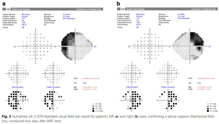 a Eos Sr-qLe Fixate. Fixatim T*get Fixatim Losses: False POS Errors: False NEG Em's: Test Ck.ratm: Fig. Artarrs's Spot 12% White 3' asb SITA.Stardard GHT: pso: I esl Outside Normal L•mitS 828 dB 0.5% Pe2% Fixatim Monit«. Fintim F Los•: False POS Errors: F "e NEG Test .3 .2 .2 Total V. Biirxj Spot 5% Vesux Acuty: White 31.5 asb SITA.Star•dMd Anny•: VFI•. C)utside Normal omits 0 Q 3 Humphrey 24-2 SITA-Standard visual field test loss, conduced two days after MRF tests result for patient's left (a) and right (b) eyes, confirming a dense superior bitemporal field 